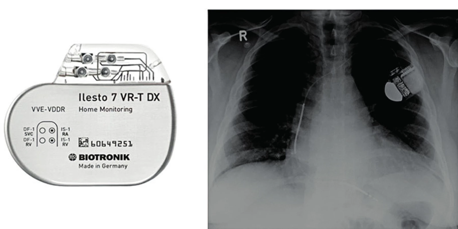 Příklad jednodutinového ICD a prostý skiagram hrudníku zachycující defibrilační elektrodu zavedenou do pravé komory srdeční