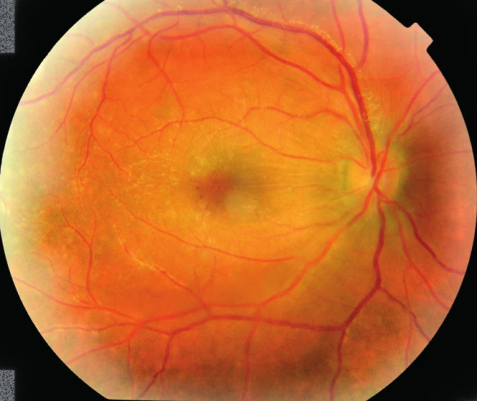 Pravé oko pacienta v 4. deň hospitalizácie.