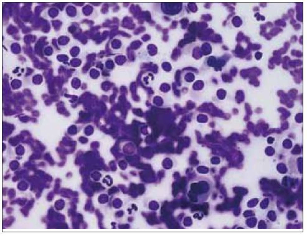 Bioptický vzorek jater v barvení hematoxylin-eozin, je patrna kulatobuněčná infiltrace s buněčnými atypiemi a dezorganizace jaterní architektury.