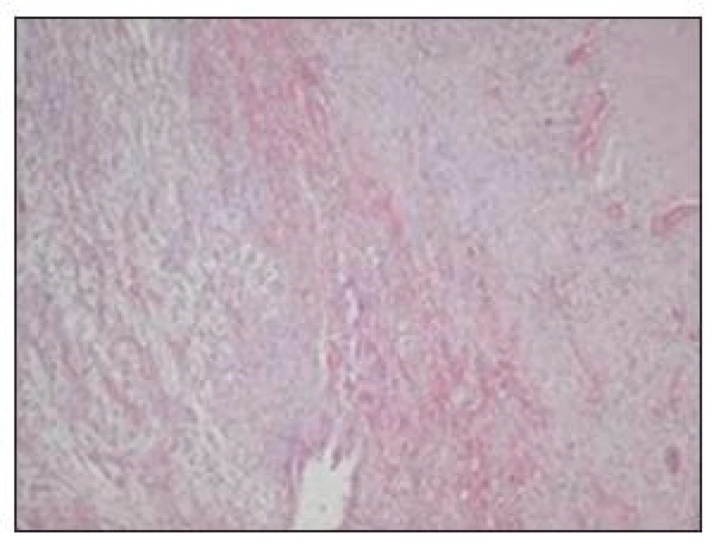 Stena čreva s časťou svalovej vrstvy s obrazom ťažkej fibrinózno-purulentnej peritonitídy v organizácii
Fig. 7. Intestinal wall with a muscle layer, signs of developing severe fibrinous purulent peritonitis