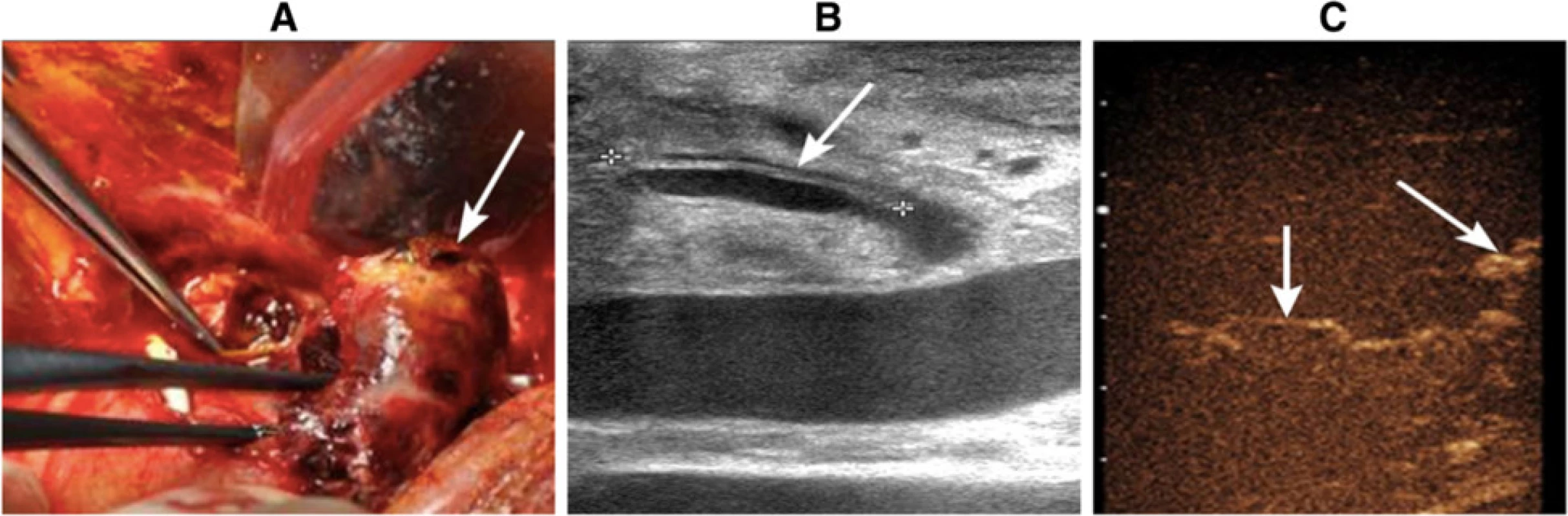 A blood clot that was 4 × 3 cm in size was found in the hilus hepatis during urgent exploratory laparotomy (&lt;i&gt;arrow&lt;/i&gt;). b Hepatic artery dissection was identified by gray-scale ultrasound. c Intraoperative CEUS revealed the opening of collateral circulation