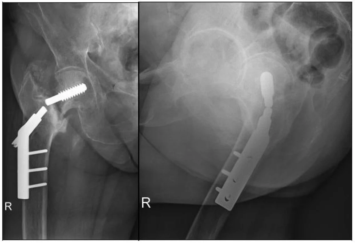 RTG dokumentace 91leté pacientky se selhanou osteosyntézou po 2 letech, stav před konverzí na CCEP
a - předozadní projekce, rozlomení šroubu DHS, pakloub v oblasti krčku femuru
b - axiální projekce, uspokojivé postavení proximální části šroubu DHS v krčku femuru