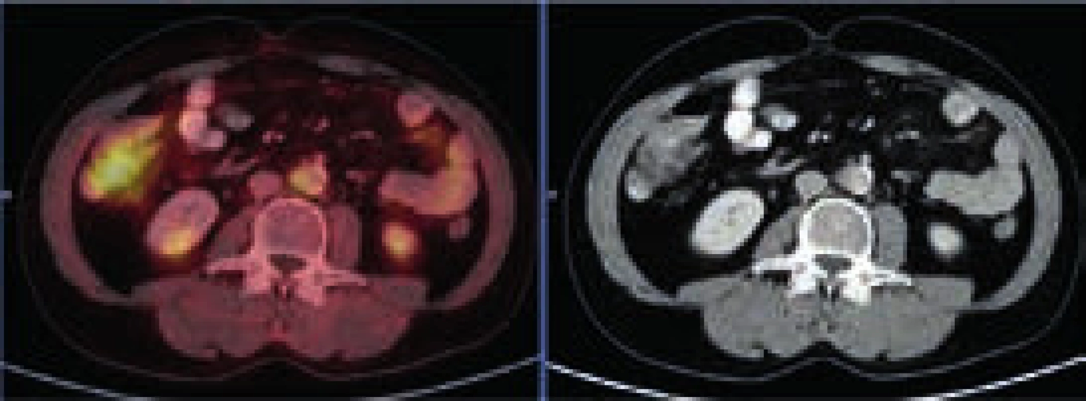 PET-CT zobrazení břicha