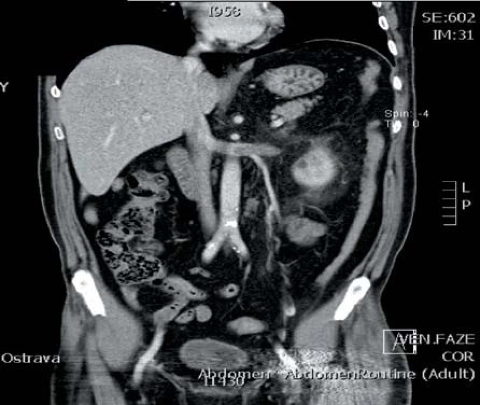 Nádorový trombus levé renální žíly zasahující v době vyšetření do úrovně aorty
Fig. 2. Tumor trombus limited to the left renal vein