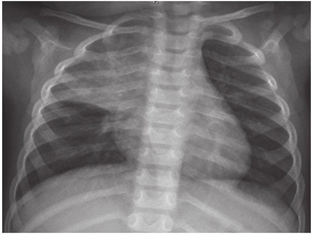 RTG snímek plic s atelektázou po 12 týdnech antituberkulózní terapie.
Fig. 3. Chest X-ray of infant with atelectasis after 12 weeks of treatment.