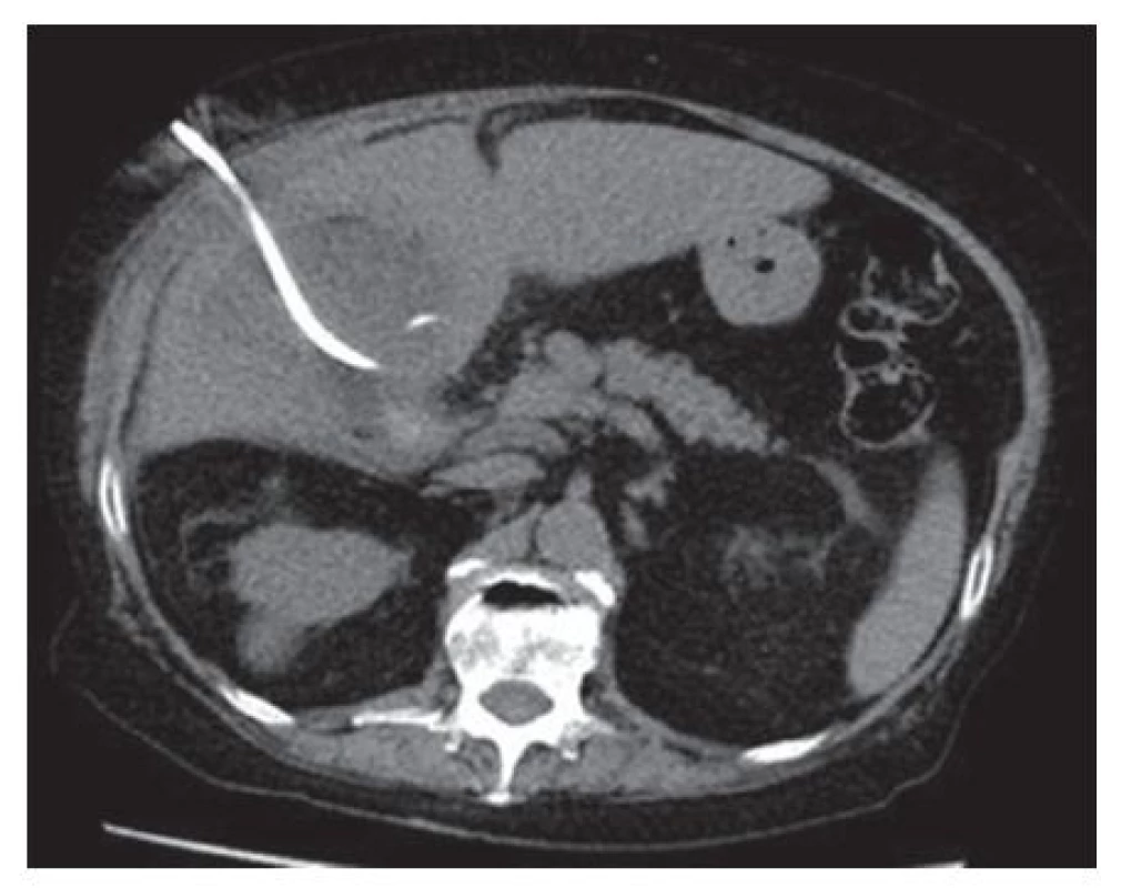 Transhepatická perkutánní drenáž žlučníku
Fig. 1: Percutaneous transhepatic gallbladder drainage