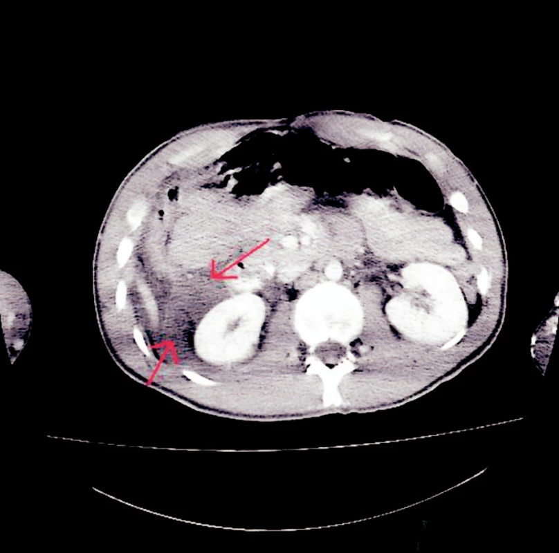 CT snímek – zvětšení množství tekutiny v hepatorenálním prostoru vpravo
Fig. 2. CT view – more fluid in the right hepatorenal region