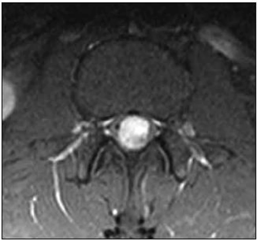 MR, T1 vážený obraz, axiální rovina. Paragangliom intradurální na etáži L1–L2, hyperintenzní tumor po podání kontrastu.
