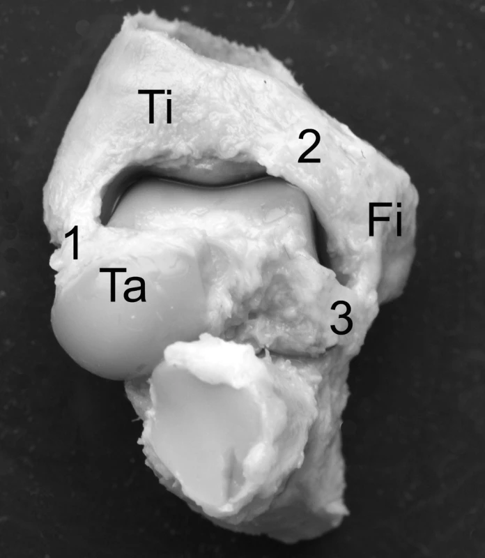 Pohled na přední plochu hlezenního kloubu v prenatálním období. 1 – lig. tibiotalare ant., 2 – lig. tibiofibulare ant., 3 – lig. fibulotalare ant. Fi – fibula, Ta – talus, Ti – tibia