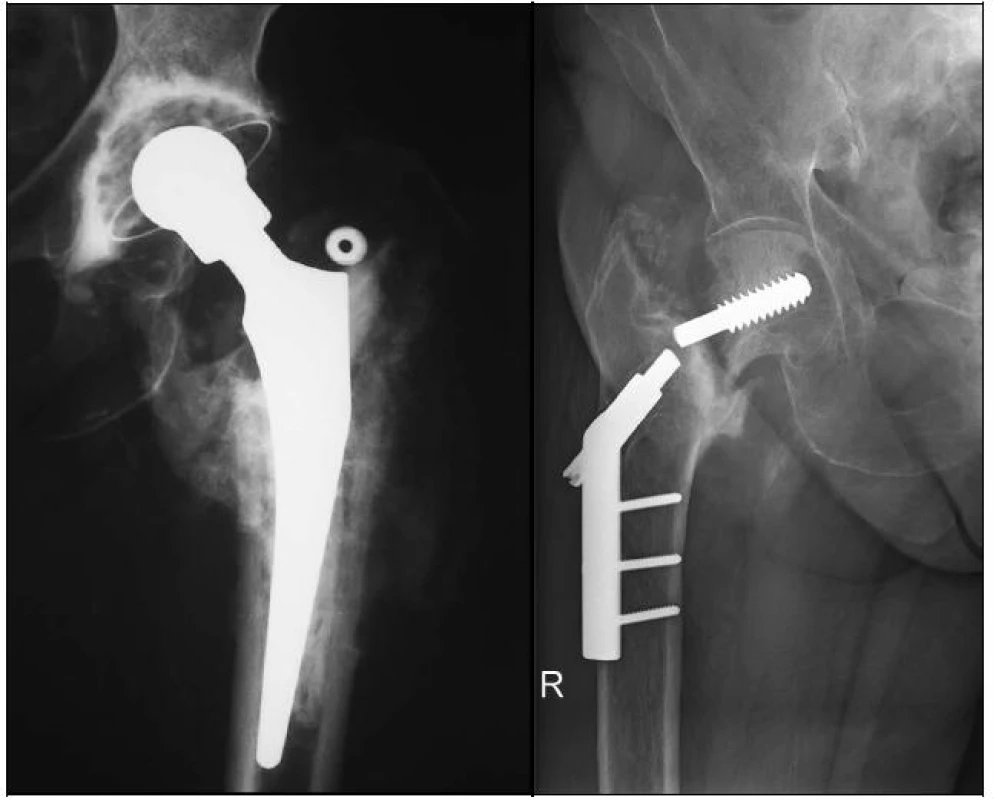 RTG dokumentace 65leté pacientky s primárně technicky špatně provedenou osteosyntézou
a - šroub DHS je zaveden příliš proximálně až mimo hlavice femuru, poškozuje acetabulum 
b - stav 2 roky po konverzi na cementovanou TEP, protéza je bez známek uvolnění