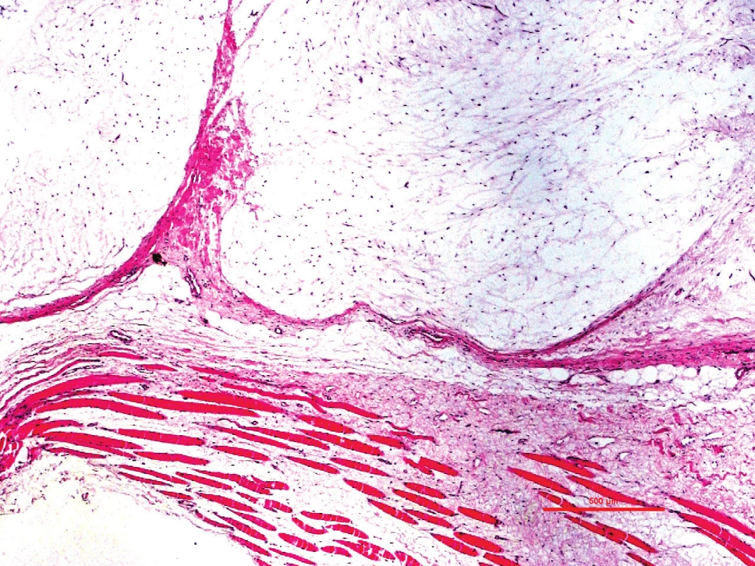Intramuskulární myxom je charakterizován hypocelularitou a blandní cytologií.