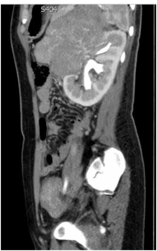 Nález tumoru levé ledviny při CT vyšetření boční projekce, vylučovací fáze.