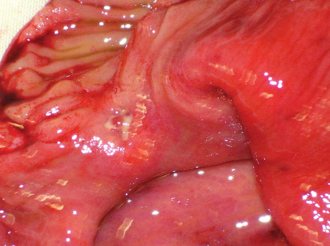 Defekt sliznice s prorůstajícím karcinoidem
Fig. 2: Mucosal defect with a carcinoid