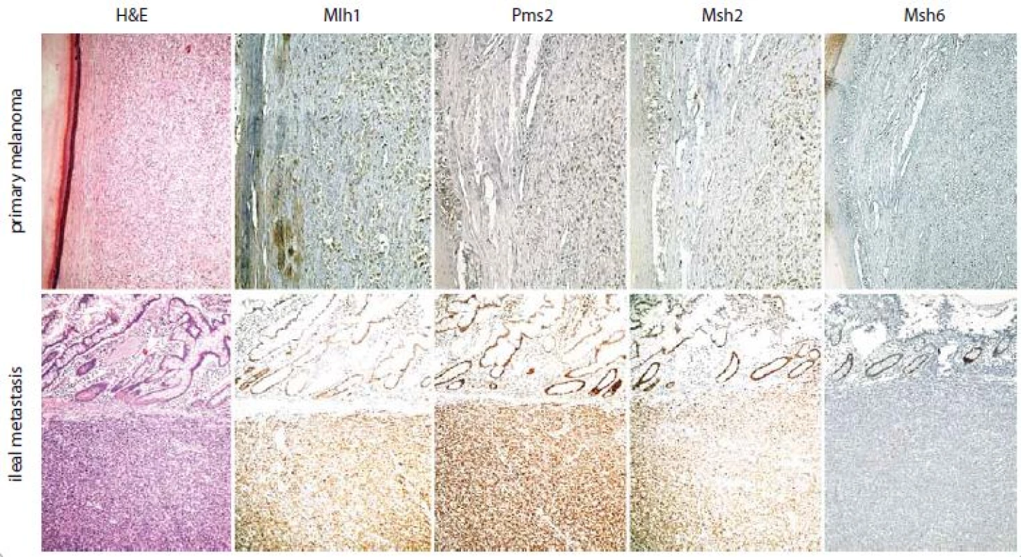 Subungual melanoma with metastatic spreading to brain and ileum in a middle aged female patient treated with significant benefit by pembrolizumab – if compared to Mlh1, Pms2 and Msh2 status, an exclusive loss of IHC expression for Msh6 protein has been ascertained.