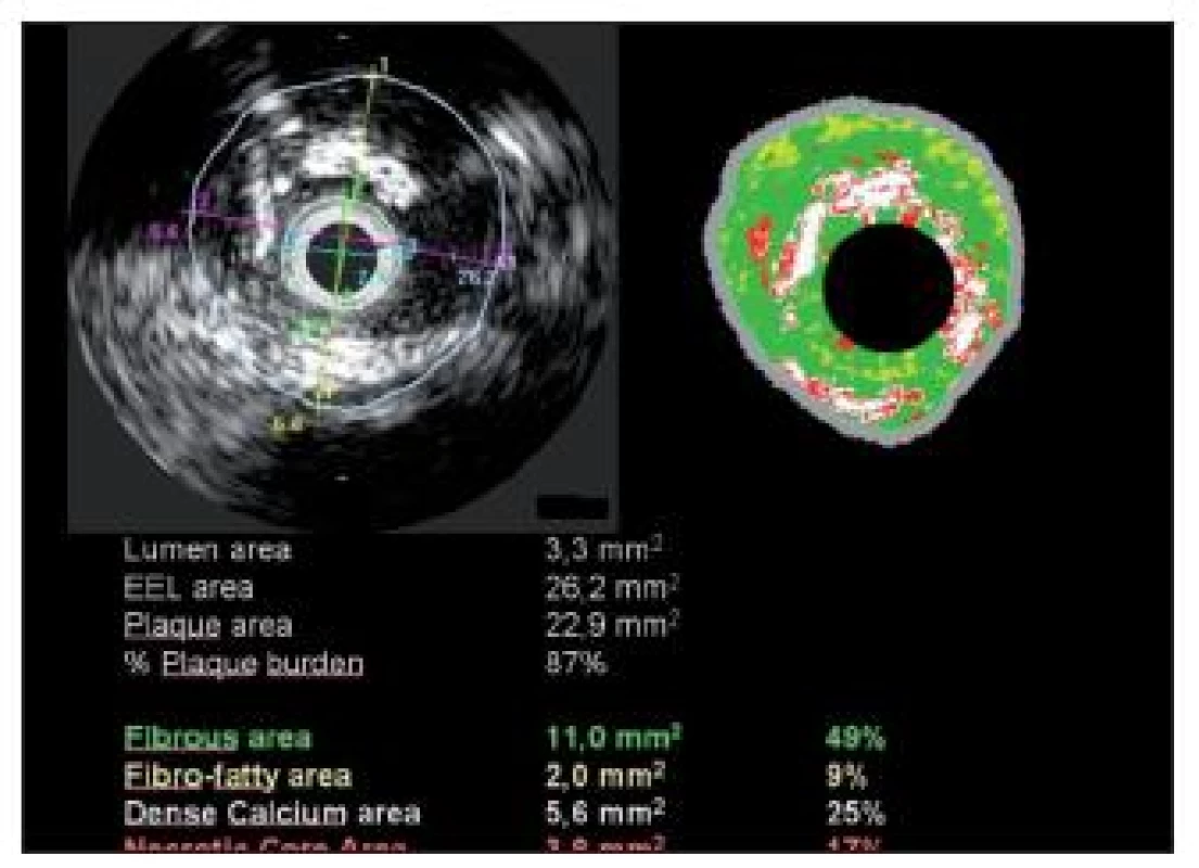 Intravaskulární ultrazvuk (levá polovina obrázku) a virtuální histologie (pravá polovina obrázku) stejné stenózy. Intravaskulární ultrazvuk zobrazí lumen cévy a její původní rozměr (lamina elastica), plocha stenózy je 87 %. Virtuální histologie v barevném rozlišení určí charakter plátu a lokalizaci jednotlivých hmot