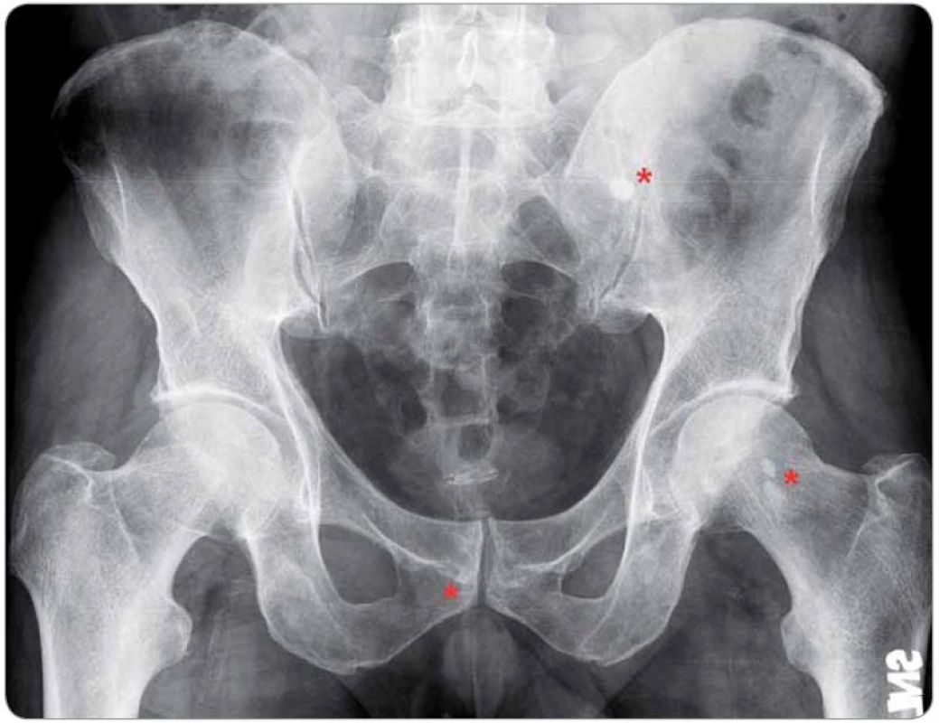 Osteoplastická ložiska ve skeletu pánve u případu 6.