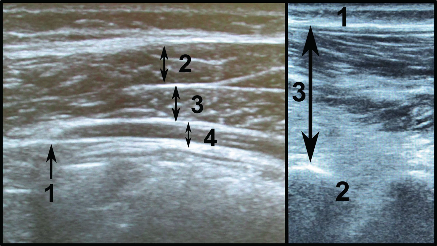 Vlevo záznam z měření břišních svalů. Poloha sondy je ustálena nalezením úponu m. transversus abdominis do thorakolumbální fascie (1).