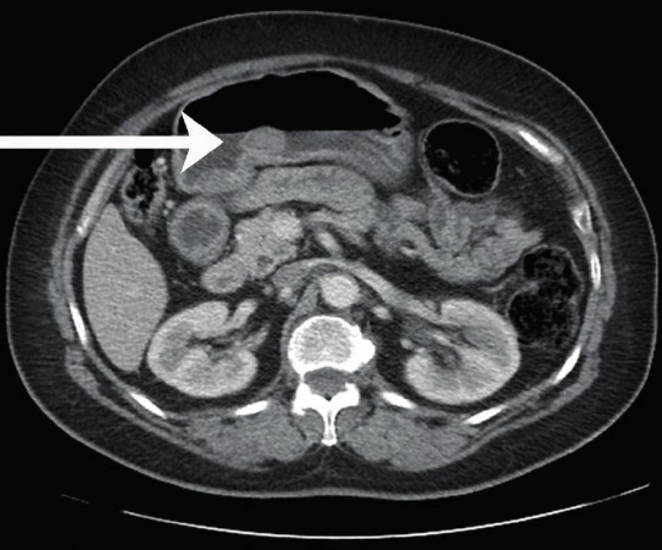 Contrast enhanced CT scan of the abdomen demonstrating a submucosal mass (white arrow) in the junction between the gastric antrum and body along the lesser curvature of the stomach.