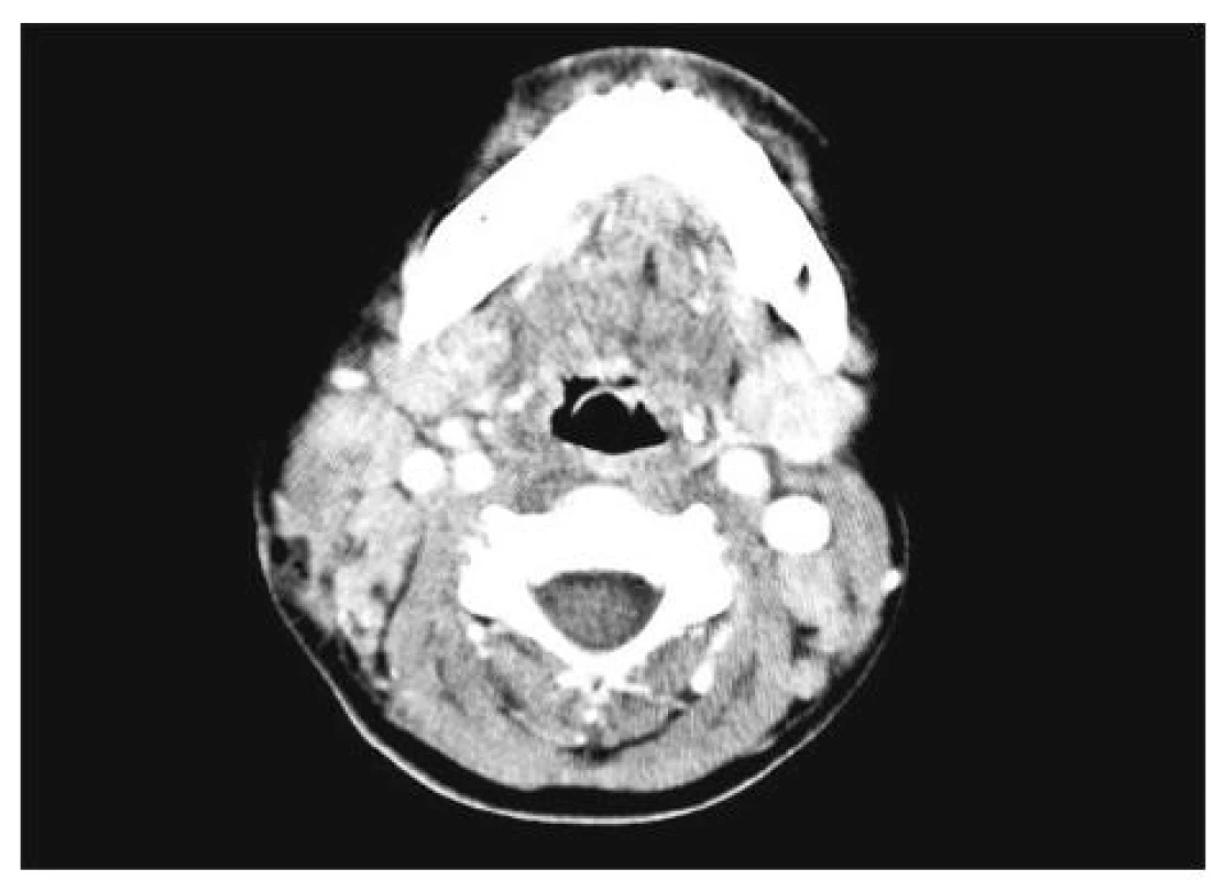 Kazuistika 1 – CT snímek krku po aplikaci kontrastní látky. Zobrazeno zvětšení krčních uzlin, zejména na pravé
straně.