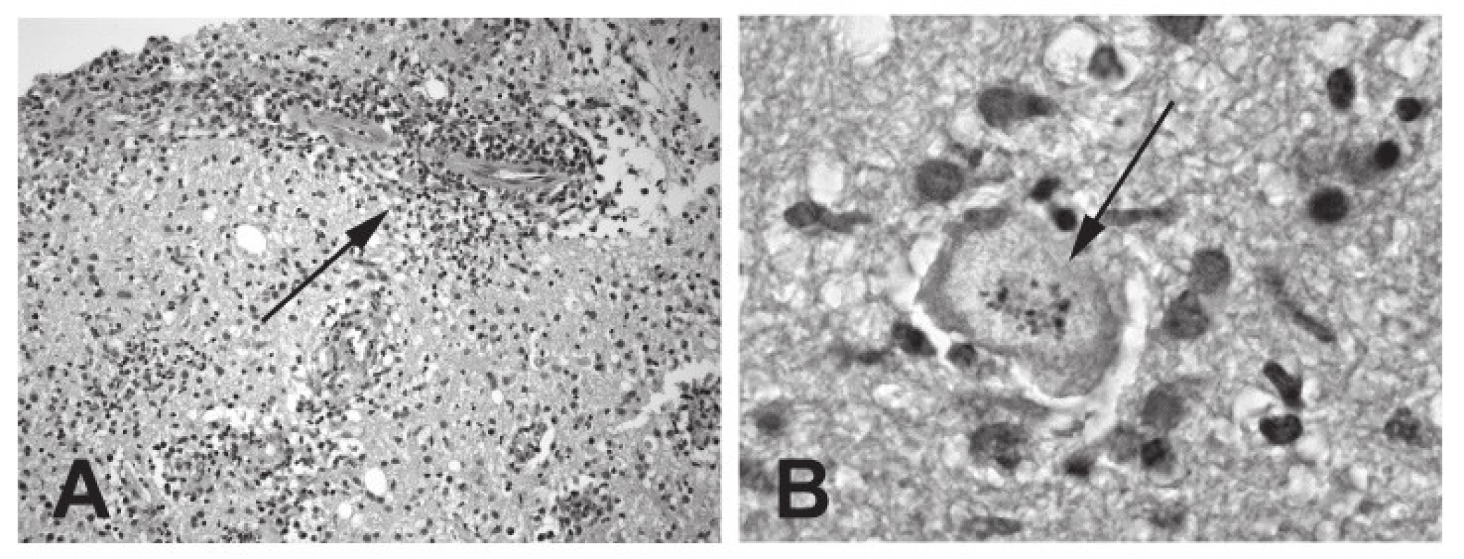 Histologický nález u mozkové toxoplazmózy (biopsie): A – perivaskulární infiltráty (označeno šipkou); B – toxoplazmová pseudocysta s intracelulárními koloniemi trofozoitů (označeno šipkou).