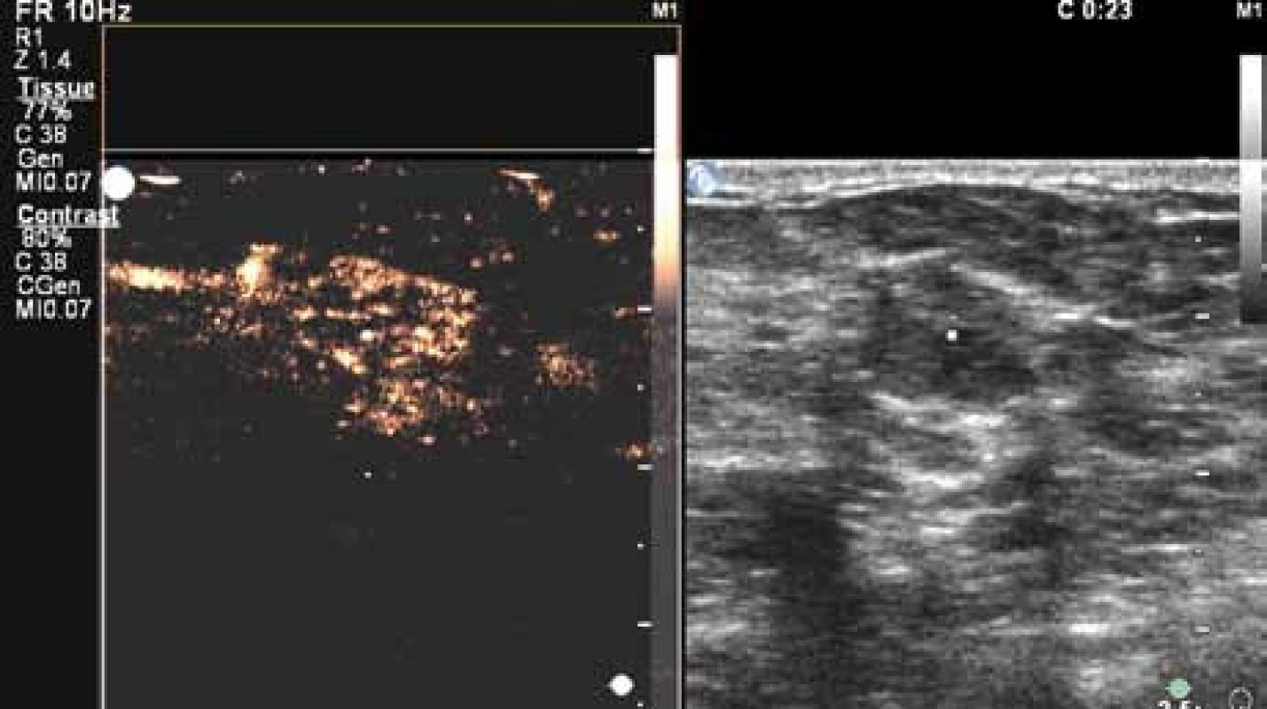 Perfuze karcinomu ve 23. sekundě vyšetření. Karcinom již vykazuje difuzní enhancement. Nadále velmi dobře patrný výrazný cévní kmen (na obrázku vlevo nahoře).