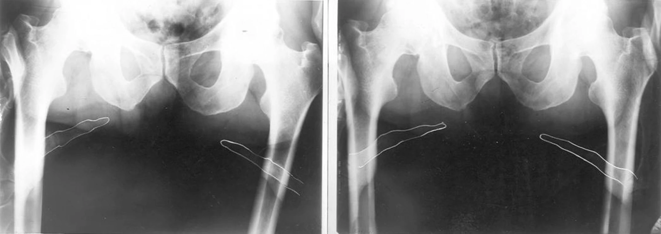 Palpační iluze: před a po terapii se postavení hrbolů sedacích kostí nezměnilo. Změnou napětí měkkých tkání se však změnilo postavení palpujících palců.
