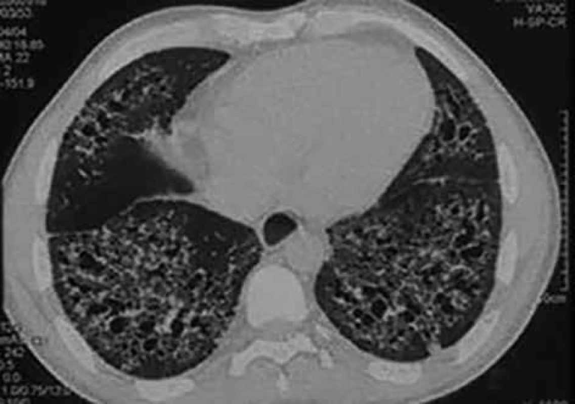 Postižení plicního intersticia u nemocného se systémovou sklerodermií vyobrazené při vyšetření vysoce rozlišovací výpočetní tomografií. Predominantní postižení je v bazálních částech plic. Prezentováno se svolením Radiodiagnostické kliniky FN Hradec Králové