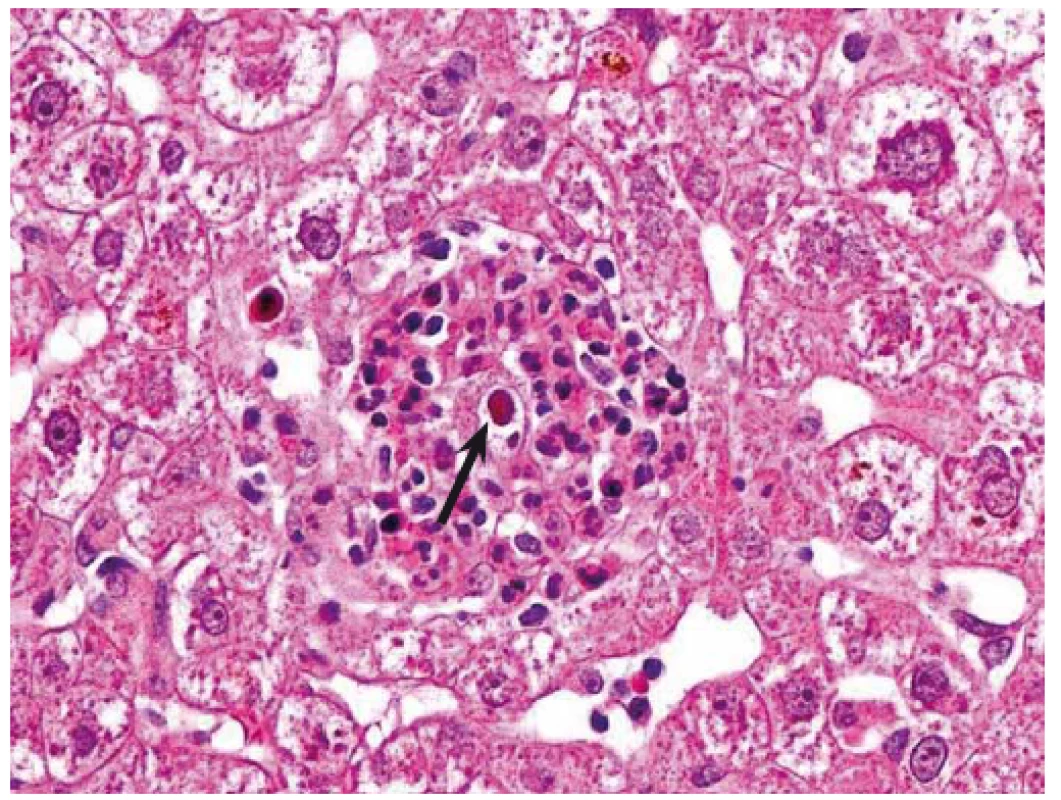 CMV hepatitida. Mikroabsces tvořený shlukem neutrofilů s intranukleární virovou inkluzí (šipka). Hematoxilin-eozin, původní zvětšení 400×.
Fig. 1. CMV hepatitis. Micro-abscess formed by a collection of neutrophils with intranuclear viral inclusion (arrow). Haematoxylin-eosin, original magnification ×400.