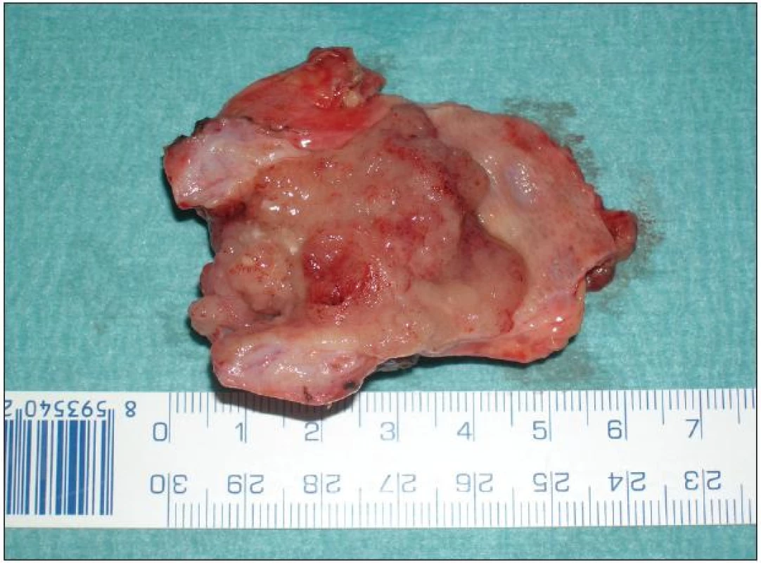 Resekát extrahepatálních žlučovodů s papilární formou Klatskinova tumoru typu Bismuth II
Fig. 7: Resection extrahepatic biliary duct for papillary type of Klatskin tumor Bismuth II