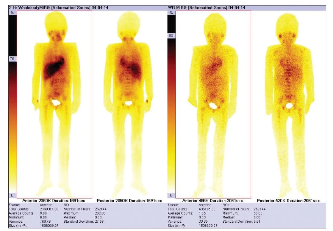 Pacient s vypočteným TMRR; celotělové oblasti zájmu s odečtem oblasti močového měchýře u pacienta s difuzním postižením neuroblastomem. Časné snímky vlevo, vpravo snímky po 24 hodinách. Vypočítané TMRR = 0,791