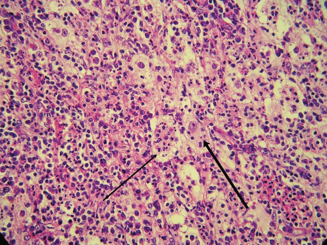 Infiltrát je tvořen velkými, histiocytům podobnými buňkami, které obsahují fagocytované lymfocyty (tlustší šipka) a polynukleáry (tenčí šipka)
(původní zvětšení 200krát)