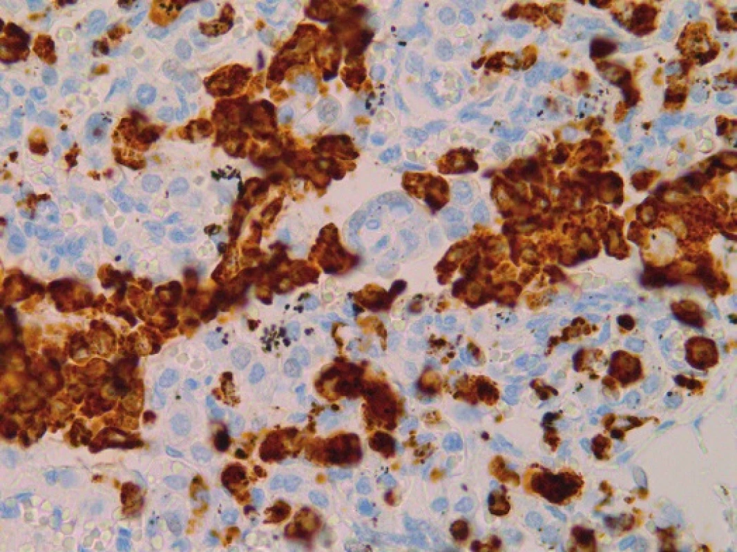 Imunohistochemický dôkaz CD68 makrofágov v pľúcnom parenchýme. Obraz koreluje s nálezmi Farkaša D. a spol. (1; anti CD68, 240x).