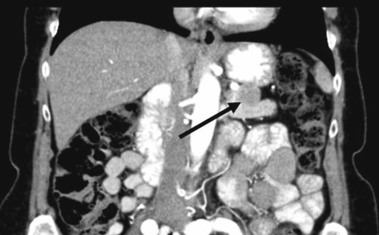 Na zadnú stenu žalúdka naliehajúci tumor prednej plochy pankreasu
Fig. 1. Anterior pancreatic tumor touching the posterior gastric wall