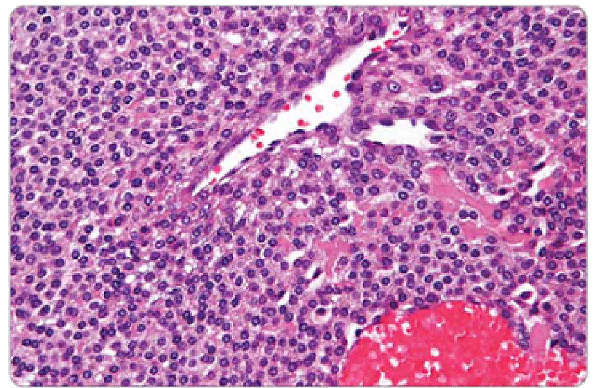 Mikroskopický obraz ukazuje krvné cievy obklopené solídnou proliferáciou dookola kuboidnými epiteloidnými bunkami s dokonale okrúhlymi jadrami a acidofilnou cytoplazmou typické pre glomus tumor [9].