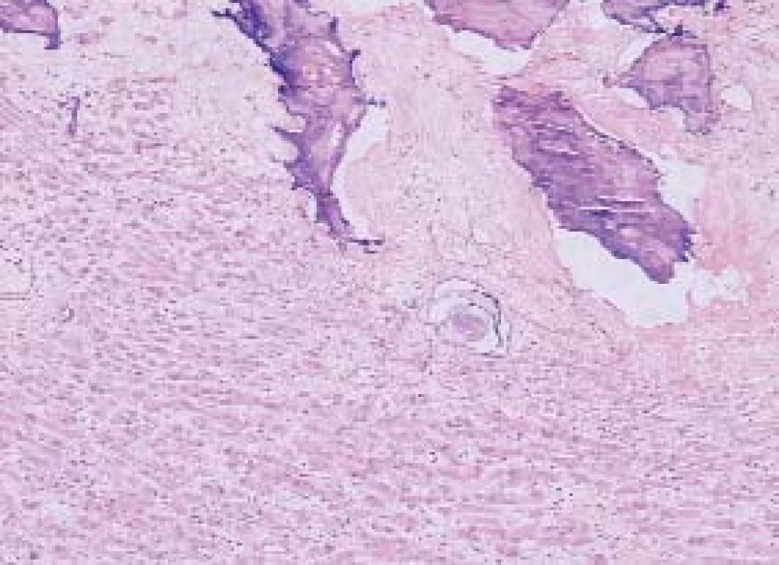 Velkobuněčný kalcifikující nádor ze Sertoliho buněk je tvořen objemnými kalcifikacemi a velkobuněčnými Sertoliánskými elementy. HE 100x.