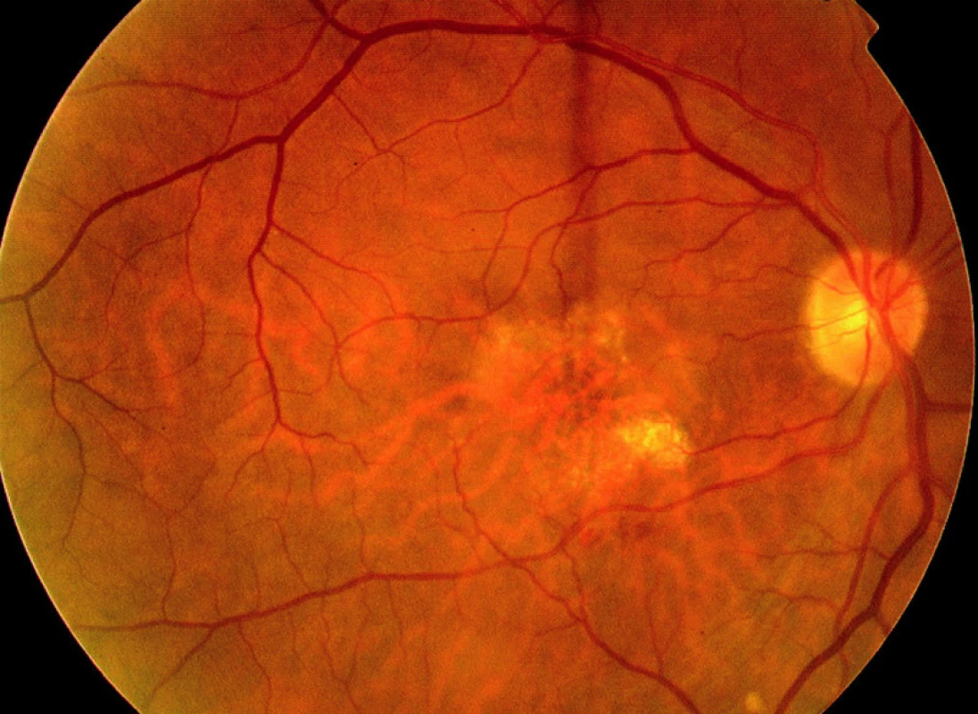 Barevný snímek fundu pravého oka pacienta 3 měsíce po FTV/RIV