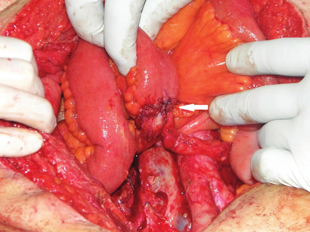 Operační nález: dokončená ureteroileo anastomóza (bílá šipka)
Fig. 7: Intraoperative finding: completed uretero-ileal anastomosis (white arrow)