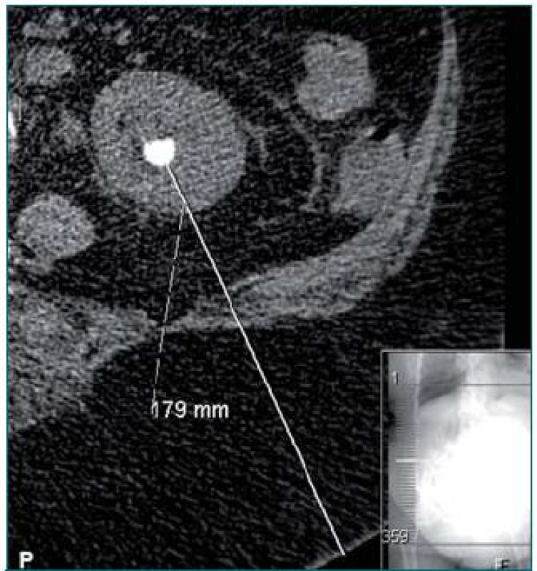 CT snímek zobrazující vzdálenost mezi konkrementem a kůží u obézních pacientů.