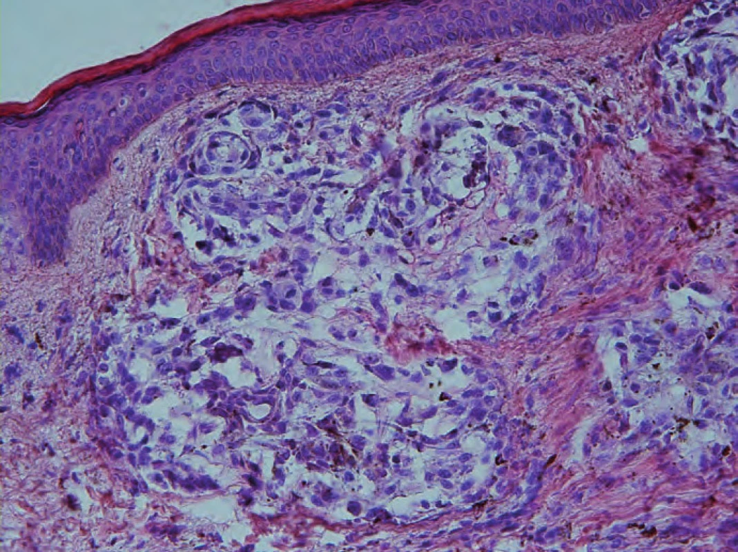 Kožní metastáza ALM, hnízda nádorových buněk v koriu.
