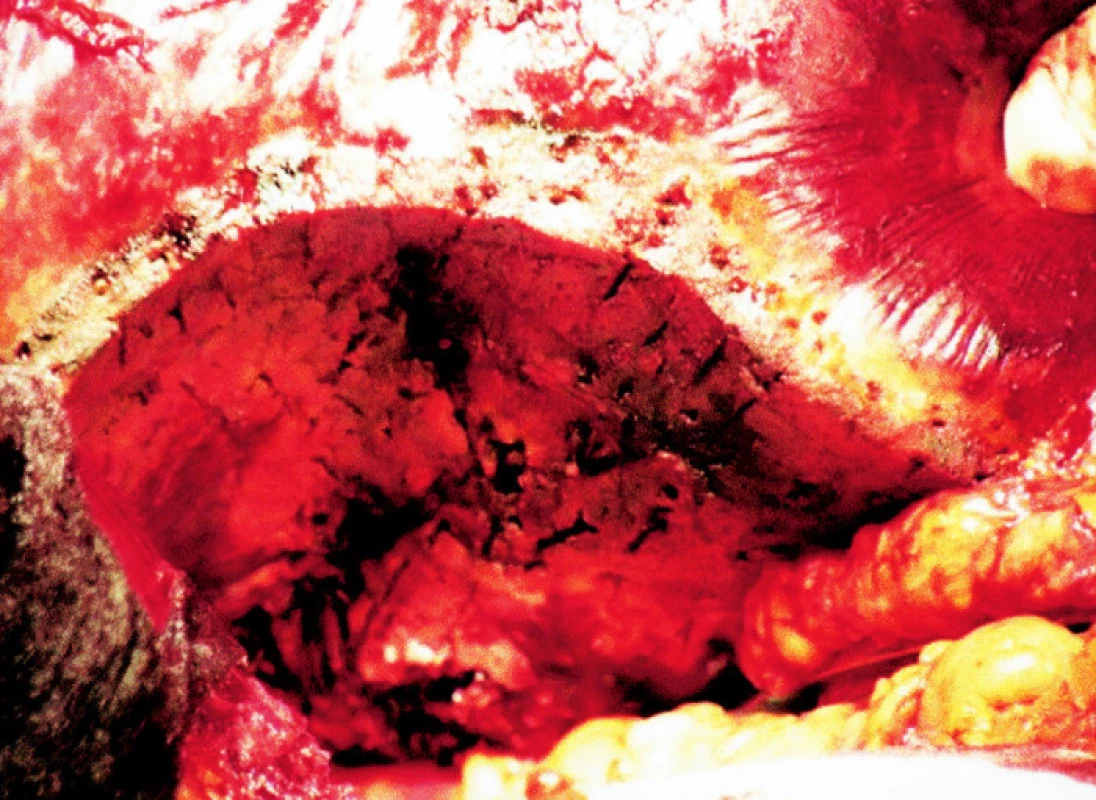 Vzhled resekčního okraje po ukončení jaterní resekce
Fig. 6. The resection edge after completion of the liver resection procedure 