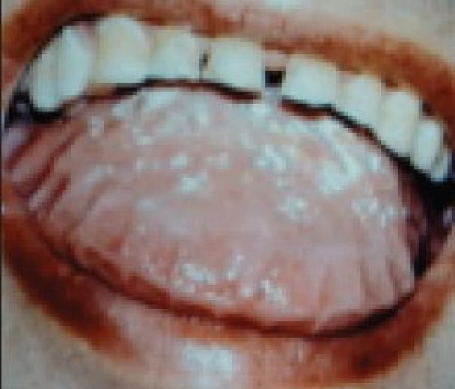 Vlevo obraz jazyka při AL amyloidóze s krvácivými projevy a vpravo jazyk zvětšený depozity amyloidu s impresemi zubů na kraji jazyka.