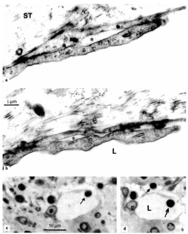 Elektrónovo-mikroskopické obrázky a mikrofotografie endotelových mikrochlopní lymfatických kapilár synoviálnej membrány od pacientky s juvenilnou idiopatickou artritídou.
a, b – ultraštruktúra špecializovaných medzibunkových spojení – endotelových mikrochlopní. Sú vytvorené prekrývajúcimi sa výbežkami susedných endotelových buniek. Vlákna z okolitého spojivového tkaniva (ST) sú zakotvené do vonkajšieho výbežku. Malé medzery (hviezdičky) sú zobrazené medzi vnútorným a vonkajším cípom. Ultratenké rezy kontrastované uranylacetátom a citranom olovnatým;
c, d – lymfocyt (šípka), ktorý vstúpil do lúmena lymfatickej kapiláry (L) cez otvorenú endotelovú mikrochlopňu. Ďalší lymfocyt (malá šípka) sa nachádza v prelymfatickom tkanivovom kanáliku – na jeho ceste z interstícia do lúmena lymfatickej kapiláry. Polotenké rezy farbené toluidínovou modrou.