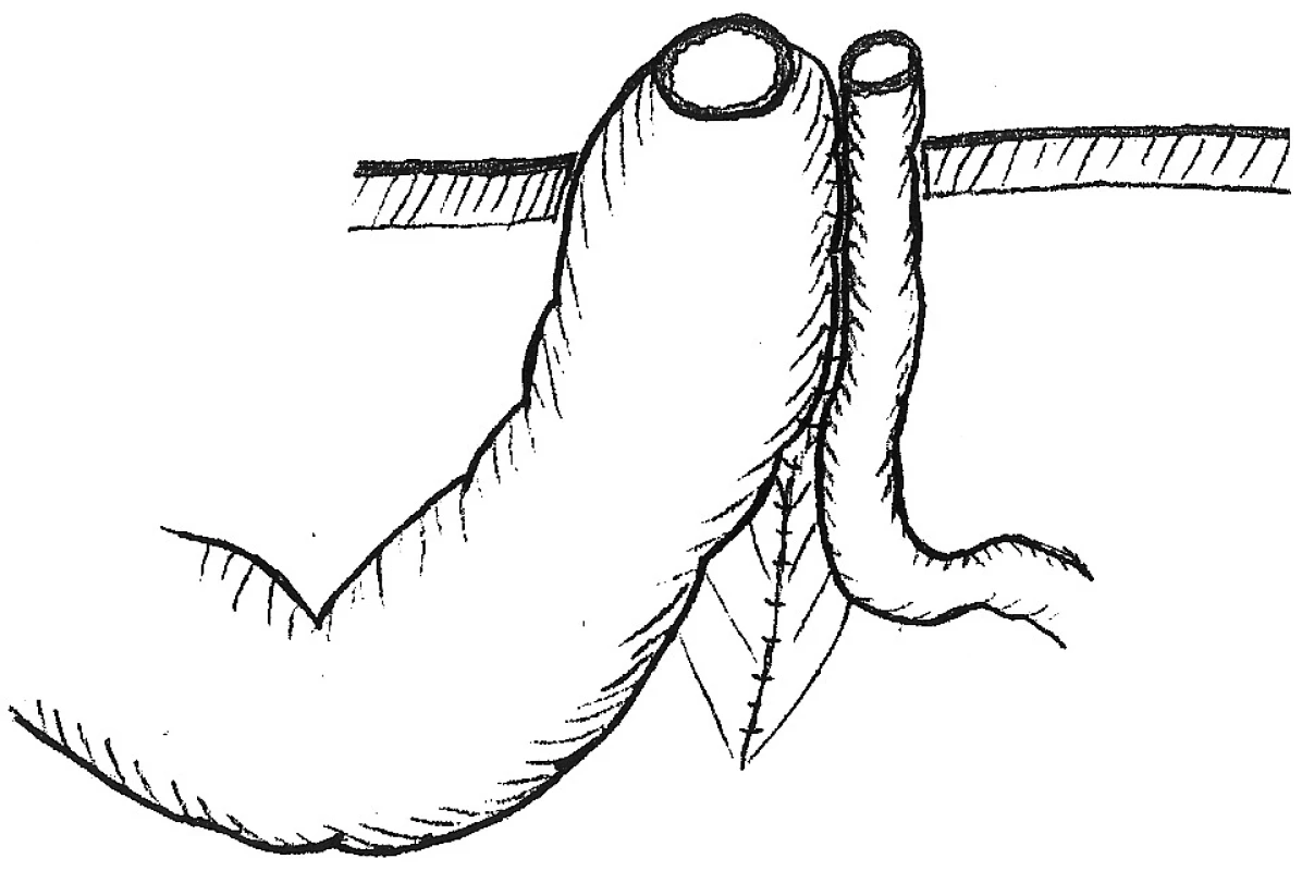 Mikuliczova enterostomia, pri ktorej sú spolu cez brušnú stenu vyvedené obidva črevné segmenty
Fig. 1. The Mikulicz enterostomy, where the both intestinal segments are taken through the abdominal wall