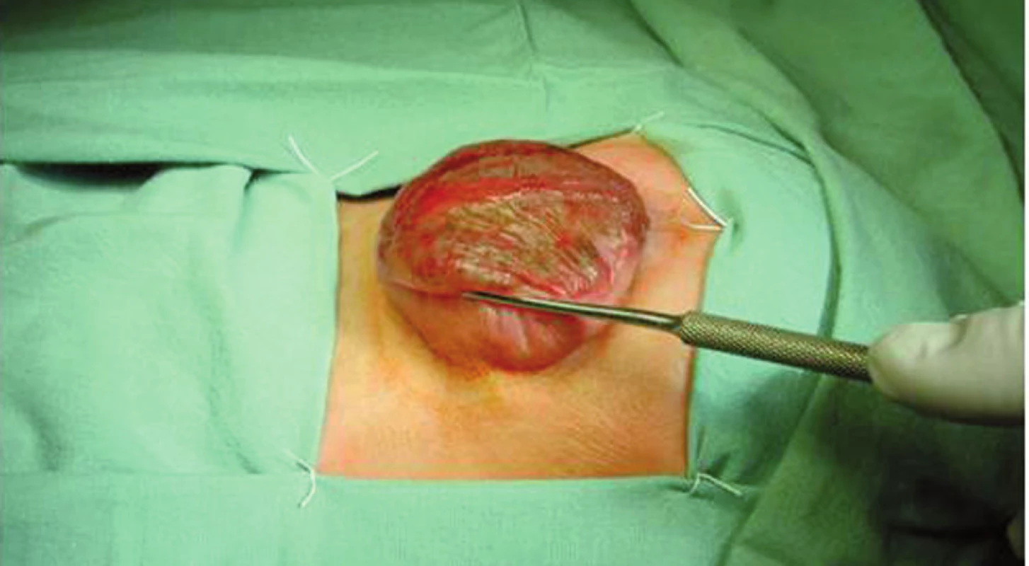 Meningomyelokéla před operací.
Fig. 2. Meningomyelocele before surgery.