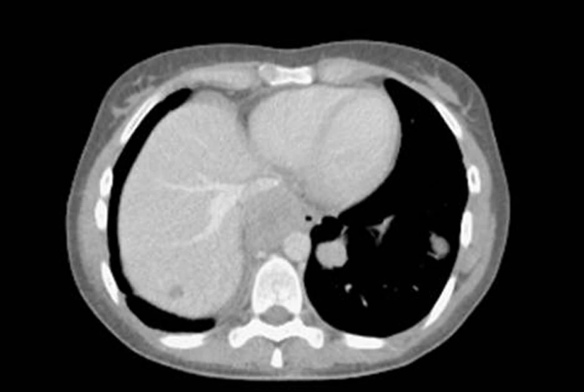 CT – velké ložisko v předním mediastinu a dvě menší ložiska synoviálního sarkomu v levé plíci.