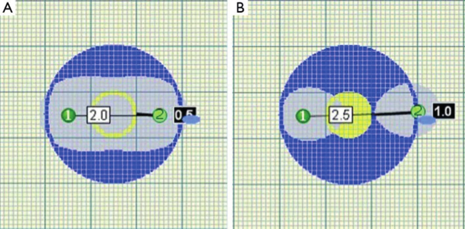 Překročení kritické vzdálenosti elektrod vede k porušení homogenity zóny ablace
Fig. 3. Homogenity of ablated area is impaired when critical distance of probes is exceeded
