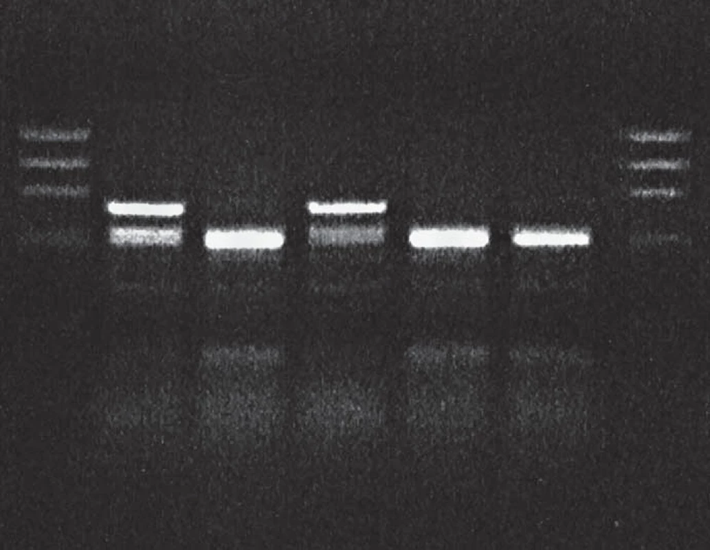 BsmA1 restriction of PCR product: proband in gCJD<sup>E200K</sup> affected family.