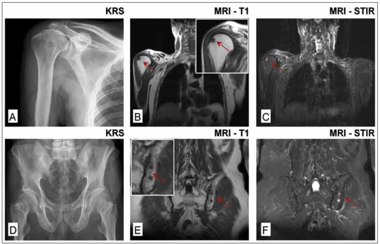 Celotělová magnetická rezonance (WB-MRI) u nemocného s prvotní diagnózou solitární formy plazmocytomu hrudní kosti vycházející z histologického vyšetření materiálu odebraného při parciální resekci sterna. Histologie kostní dřeně z lopaty kosti kyčelní byla negativní, zaznamenána i negativita MIg a normální hodnoty volných lehkých řetězců &amp;kappa; a &amp;lambda; v séru, negativita konvenční radiografie skeletu, &lt;sup&gt;99m&lt;/sup&gt;TcMIBI scintigrafie a &lt;sup&gt;18&lt;/sup&gt;F-FDG PET/CT.
WB-MRI prokázala na rozdíl od konvenčního radiografického vyšetření pravého humeru a pánve (obr. 1A a 1D) ložiskové léze v hlavici pravého humeru (obr. 1B a 1C) a difuzní postižení pánve a kosti křížové s přítomností 2 ložisek v sousedství sakroiliakálního skloubení (1E a 1F).