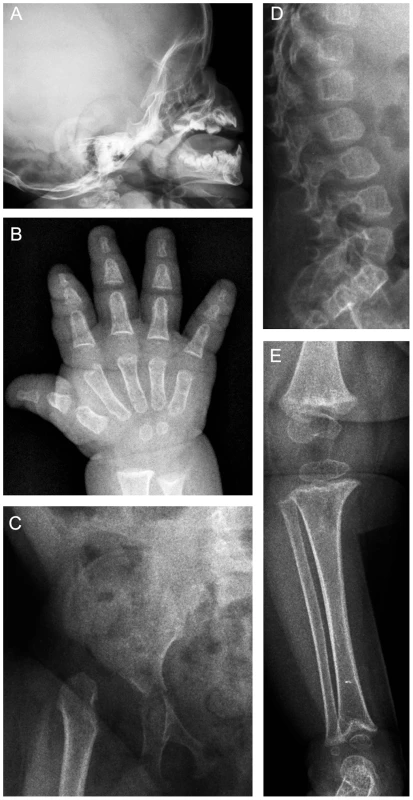 Radiographs of patient 1 at 13 months of age.