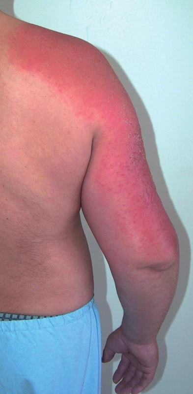 Fotoalergická kontaktní dermatitida na pravé paži a na rameni (ketoprofen).